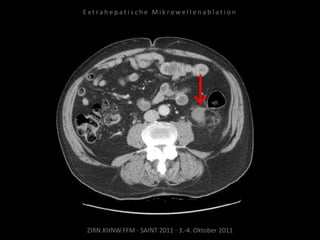 ZIRN.KHNW.FFM · SAINT 2011 · 3.-4. Oktober 2011
E x t r a h e p a t i s c h e M i k r o w e l l e n a b l a t i o n
 