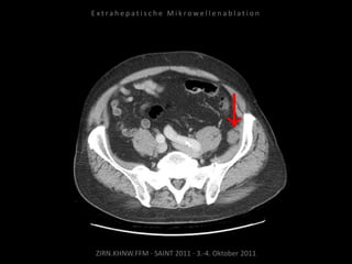 ZIRN.KHNW.FFM · SAINT 2011 · 3.-4. Oktober 2011
E x t r a h e p a t i s c h e M i k r o w e l l e n a b l a t i o n
 