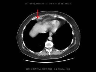 ZIRN.KHNW.FFM · SAINT 2011 · 3.-4. Oktober 2011
E x t r a h e p a t i s c h e M i k r o w e l l e n a b l a t i o n
 