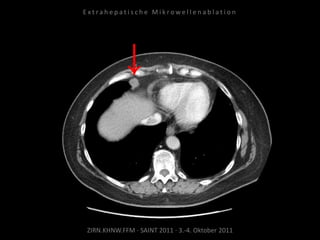 ZIRN.KHNW.FFM · SAINT 2011 · 3.-4. Oktober 2011
E x t r a h e p a t i s c h e M i k r o w e l l e n a b l a t i o n
 