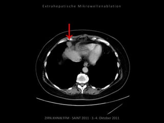 ZIRN.KHNW.FFM · SAINT 2011 · 3.-4. Oktober 2011
E x t r a h e p a t i s c h e M i k r o w e l l e n a b l a t i o n
 
