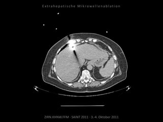 ZIRN.KHNW.FFM · SAINT 2011 · 3.-4. Oktober 2011
E x t r a h e p a t i s c h e M i k r o w e l l e n a b l a t i o n
 