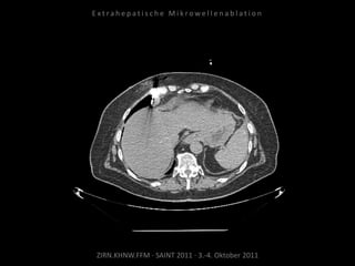 ZIRN.KHNW.FFM · SAINT 2011 · 3.-4. Oktober 2011
E x t r a h e p a t i s c h e M i k r o w e l l e n a b l a t i o n
 
