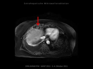 ZIRN.KHNW.FFM · SAINT 2011 · 3.-4. Oktober 2011
E x t r a h e p a t i s c h e M i k r o w e l l e n a b l a t i o n
 