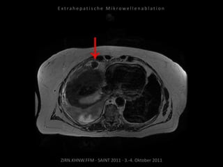 ZIRN.KHNW.FFM · SAINT 2011 · 3.-4. Oktober 2011
E x t r a h e p a t i s c h e M i k r o w e l l e n a b l a t i o n
 