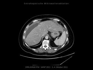ZIRN.KHNW.FFM · SAINT 2011 · 3.-4. Oktober 2011
E x t r a h e p a t i s c h e M i k r o w e l l e n a b l a t i o n
 