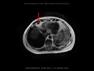 ZIRN.KHNW.FFM · SAINT 2011 · 3.-4. Oktober 2011
E x t r a h e p a t i s c h e M i k r o w e l l e n a b l a t i o n
 