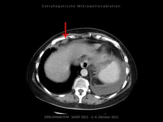 ZIRN.KHNW.FFM · SAINT 2011 · 3.-4. Oktober 2011
E x t r a h e p a t i s c h e M i k r o w e l l e n a b l a t i o n
 