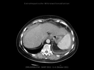 ZIRN.KHNW.FFM · SAINT 2011 · 3.-4. Oktober 2011
E x t r a h e p a t i s c h e M i k r o w e l l e n a b l a t i o n
 
