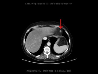 ZIRN.KHNW.FFM · SAINT 2011 · 3.-4. Oktober 2011
E x t r a h e p a t i s c h e M i k r o w e l l e n a b l a t i o n
 