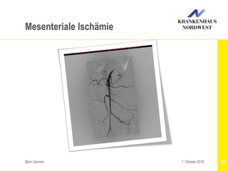Björn Gemein 1041. Oktober 2016
Mesenteriale Ischämie
 