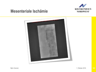 Björn Gemein 1051. Oktober 2016
Mesenteriale Ischämie
 