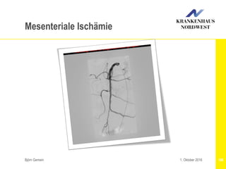 Björn Gemein 1061. Oktober 2016
Mesenteriale Ischämie
 