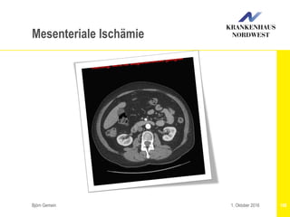 Björn Gemein 1081. Oktober 2016
Mesenteriale Ischämie
 
