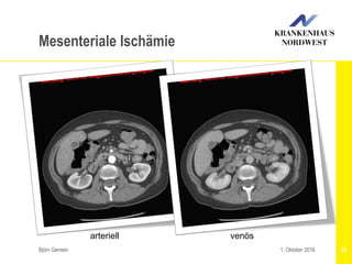Björn Gemein 251. Oktober 2016
Mesenteriale Ischämie
venösarteriell
 