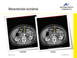 Björn Gemein 271. Oktober 2016
Mesenteriale Ischämie
arteriell venös
 