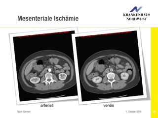 Björn Gemein 281. Oktober 2016
Mesenteriale Ischämie
arteriell venös
 