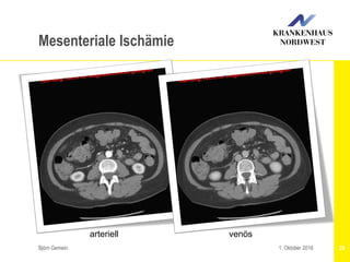 Björn Gemein 291. Oktober 2016
Mesenteriale Ischämie
arteriell venös
 