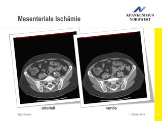 Björn Gemein 301. Oktober 2016
Mesenteriale Ischämie
arteriell venös
 