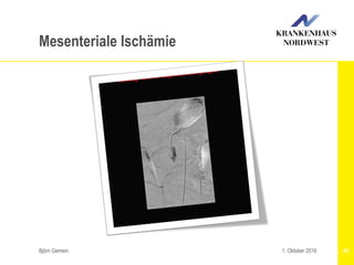 Björn Gemein 431. Oktober 2016
Mesenteriale Ischämie
 