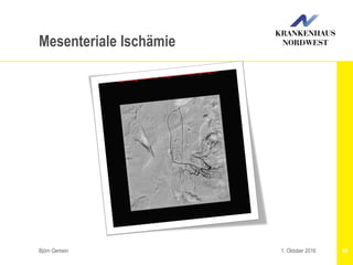 Björn Gemein 491. Oktober 2016
Mesenteriale Ischämie
 