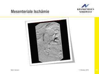 Björn Gemein 501. Oktober 2016
Mesenteriale Ischämie
 