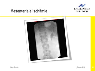 Björn Gemein 521. Oktober 2016
Mesenteriale Ischämie
 