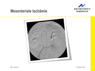 Björn Gemein 531. Oktober 2016
Mesenteriale Ischämie
 