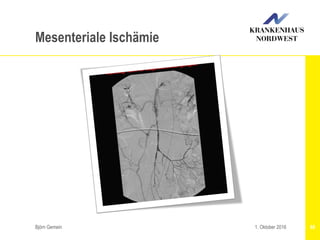 Björn Gemein 681. Oktober 2016
Mesenteriale Ischämie
 