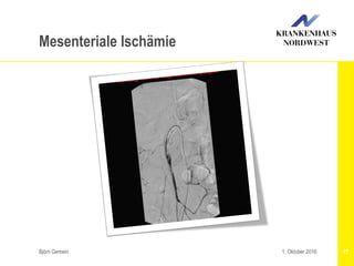 Björn Gemein 771. Oktober 2016
Mesenteriale Ischämie
 