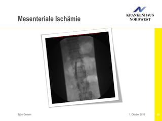 Björn Gemein 781. Oktober 2016
Mesenteriale Ischämie
 
