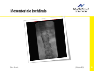 Björn Gemein 801. Oktober 2016
Mesenteriale Ischämie
 