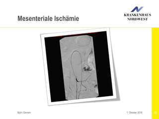Björn Gemein 831. Oktober 2016
Mesenteriale Ischämie
 