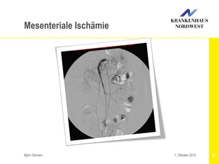 Björn Gemein 851. Oktober 2016
Mesenteriale Ischämie
 