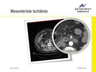 Björn Gemein 921. Oktober 2016
Mesenteriale Ischämie
 