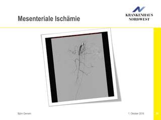 Björn Gemein 961. Oktober 2016
Mesenteriale Ischämie
 