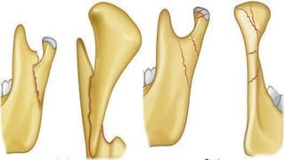 Condylar fracture | PPTX