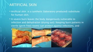 ARTIFICIAL SKIN
• Artificial skin is a synthetic (laboratory produced) substitute
for human skin.
• A severe burn leaves the body dangerously vulnerable to
infection and dehydration (drying out). Keeping burn patients in
sterile (germ free) rooms can protect against infections, and
covering burned areas with grafts.
 