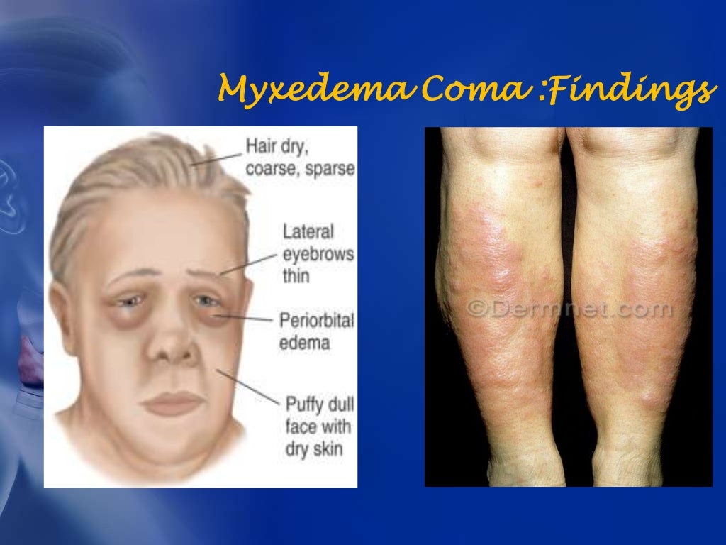 HYPOTHYROIDISM.& MYXEDEMA CRISIS