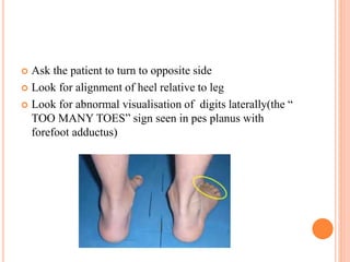  Ask the patient to turn to opposite side
 Look for alignment of heel relative to leg
 Look for abnormal visualisation ...