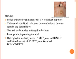 3)TOES
 notice transverse skin crease at I-P joint(lost in polio)
 Thickened cornified skin over dorsum(heloma durum)
se...