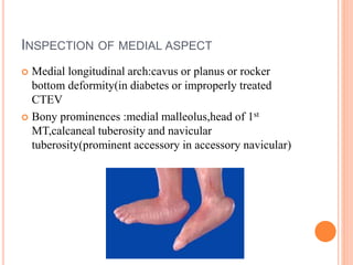INSPECTION OF MEDIAL ASPECT
 Medial longitudinal arch:cavus or planus or rocker
bottom deformity(in diabetes or improperl...