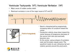 Ventricular Tachycardia (VT), Ventricular fibrillation （VF)
• Major cause of sudden cardiac death
• Reentrant excitation is one of the major cause of VT and VF

• Spiral is characterized by progressively
increasing radius of curvature toward the
center.
• Conduction velocity slows down toward the
center because of progressive decrease of
the source/sink ratio and eventually
becomes zero.
• At the center, various phases of excitation
meet and formulate singular point. The
wavefront meets its own refractory tail and
rotation persists around this pivot point.
7

 