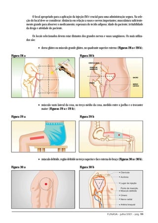 O local apropriado para a aplicação da injeção IM é crucial para uma administração segura. Na sele-
              ção do local deve-se considerar: distância em relação a vasos e nervos importantes; musculatura suficiente-
              mente grande para absorver o medicamento; espessura do tecido adiposo; idade do paciente; irritabilidade
              da droga e atividade do paciente.

                   Os locais selecionados devem estar distantes dos grandes nervos e vasos sangüíneos. Os mais utiliza-
              dos são:

                        • dorso glúteo ou músculo grande glúteo, no quadrante superior externo (Figuras 28 a e 28 b);

Figura 28 a                                                    Figura 28 b




                        • músculo vasto lateral da coxa, no terço médio da coxa, medido entre o joelho e o trocanter
                          maior (Figuras 29 a e 29 b);

Figura 29 a                                                    Figura 29 b




                        • músculo deltóide, região deltóide no terço superior e face externa do braço (Figuras 30 a e 30 b).

Figura 30 a                                                    Figura 30 b




                                                                                         FUNASA - julho/2001 - pág. 99
 