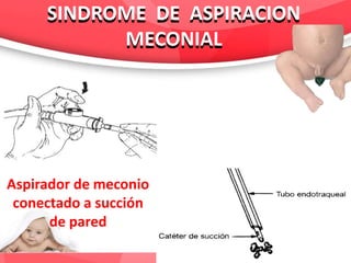 Dr. Edwin Villacorta
SINDROME DE ASPIRACION
MECONIAL
SINDROME DE ASPIRACION
MECONIAL
Aspirador de meconio
conectado a succión
de pared
 