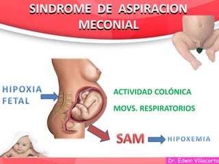 Dr. Edwin Villacorta
ACTIVIDAD COLÓNICA
MOVS. RESPIRATORIOS
SINDROME DE ASPIRACION
MECONIAL
SINDROME DE ASPIRACION
MECONIAL
 