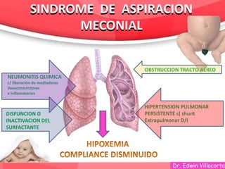 Dr. Edwin Villacorta
SINDROME DE ASPIRACION
MECONIAL
SINDROME DE ASPIRACION
MECONIAL
OBSTRUCCION TRACTO AÉREO
DISFUNCION O
INACTIVACION DEL
SURFACTANTE
NEUMONITIS QUIMICA
c/ liberación de mediadores
Vasoconstrictores
e inflamatorios
HIPERTENSION PULMONAR
PERSISTENTE c( shunt
Extrapulmonar D/I
 