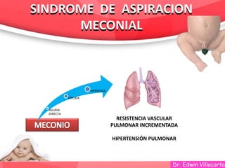 Dr. Edwin Villacorta
SINDROME DE ASPIRACION
MECONIAL
SINDROME DE ASPIRACION
MECONIAL
RESISTENCIA VASCULAR
PULMONAR INCREMENTADA
HIPERTENSIÓN PULMONAR
INJURIA
DIRECTA
HIPOXIA
HIPEROXIA
 