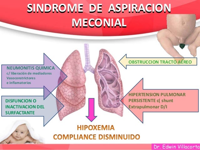 Sindrome De Aspiracion De Meconio Dibujo