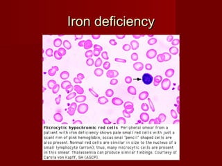 IIrroonn ddeeffiicciieennccyy 
 